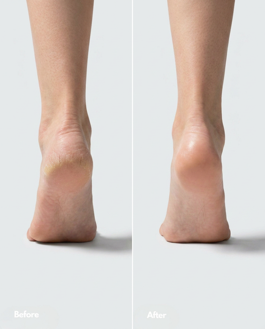 Heald - 60% Urea Heel Repair Balm